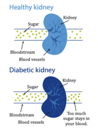 Diabetes And Kidney Disease | American Kidney Fund