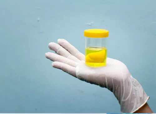 Gloved hand holding a urine sample container with yellow urine