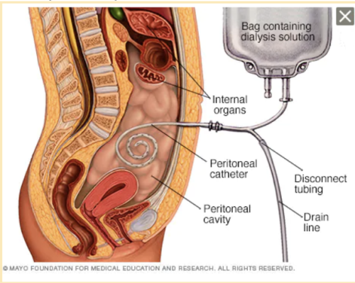 Peritoneal Dialysis Page Diagram Illustration ?itok= 3fYucwf
