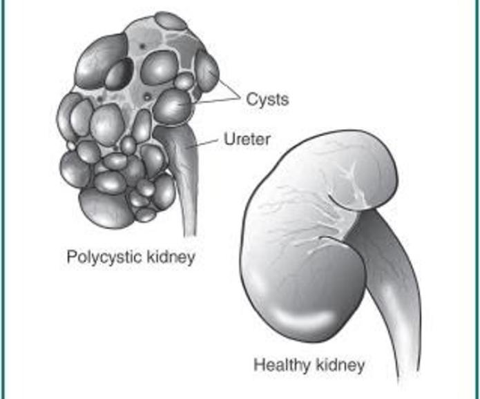 Polycystic Kidney Disease (PKD) Symptoms, Treatments & Causes ...